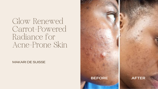 Reveal Radiance: How Carotonic Toning Serum Transforms Oily & Acne-Prone Skin