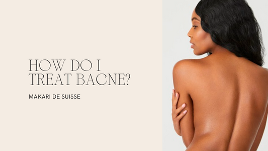 How Do I Treat Bacne?